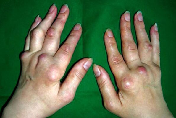 Von Polyosteoarthritis deformans betroffene Hände