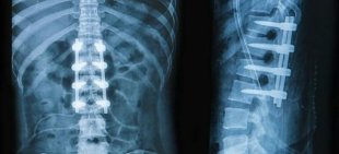Röntgen-Rücken