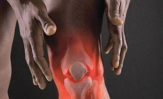 Arthrose geht mit einem Entzündungsprozess im Kniegelenk einher