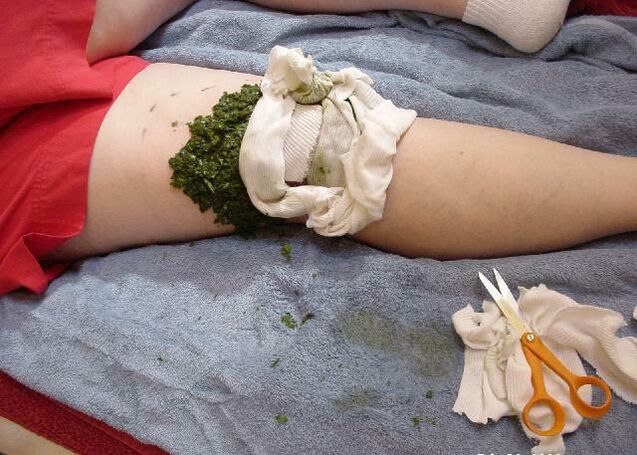 Eine warme Kompresse aus zerdrückten Kohlblättern auf einem schmerzenden Kniegelenk mit Arthrose